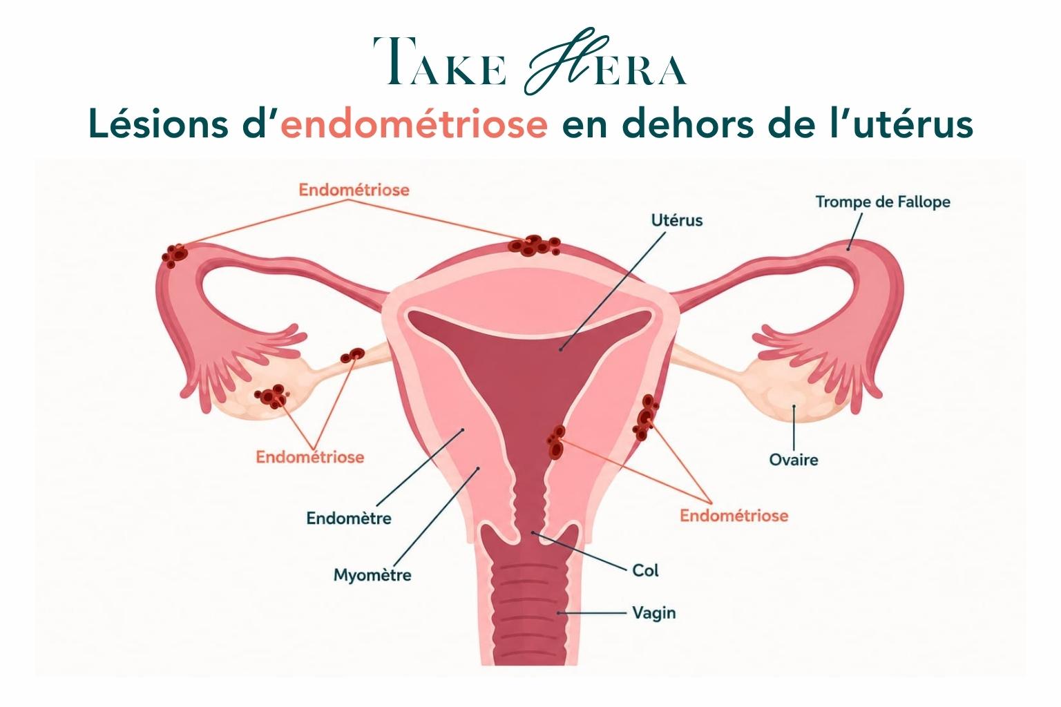 Illustration médicale des lésions liées à l'endométriose